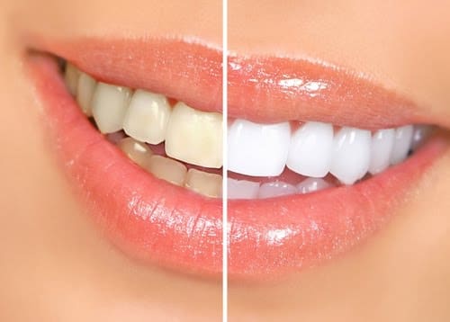 Teeth Whitening | Mosaic Dental Center Orlando, Florida Teeth Whitening Orlando, Florida | Mosaic Dental Center